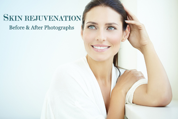 Skin Rejuvenation