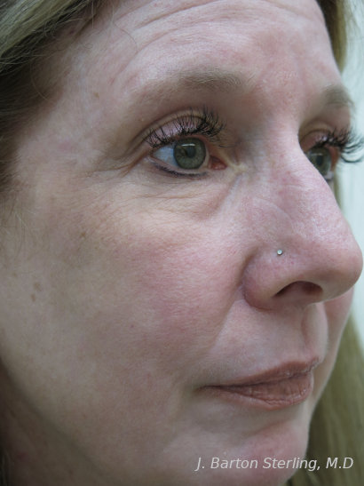 Chemical Peel106 After