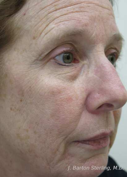 Chemical Peel 106 Before