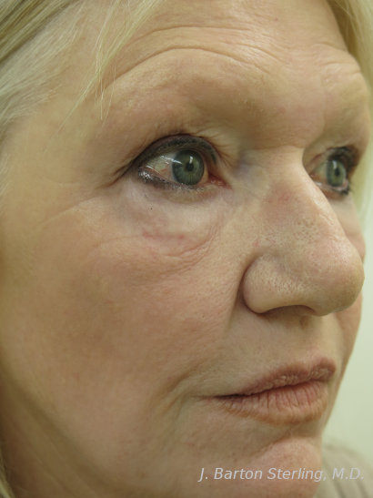 Chemical Peel 115 After