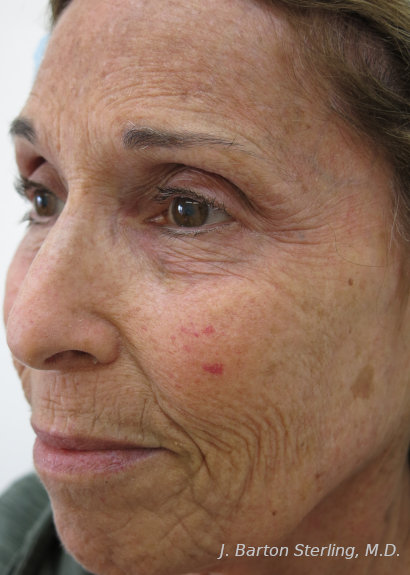 Chemical Peel 2024_2 Before