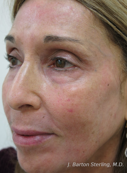 Chemical Peel 2024_2 After