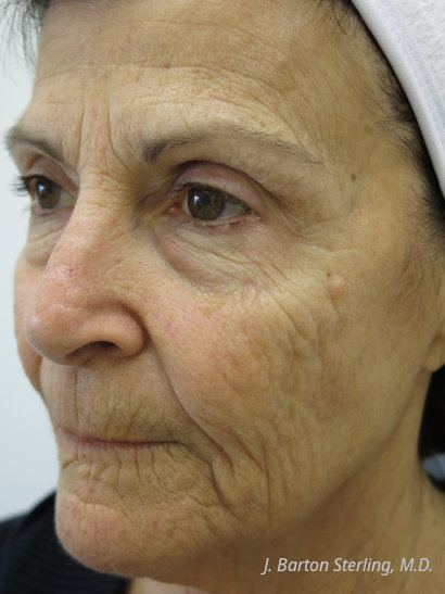 Chemical Peel 2025 Before