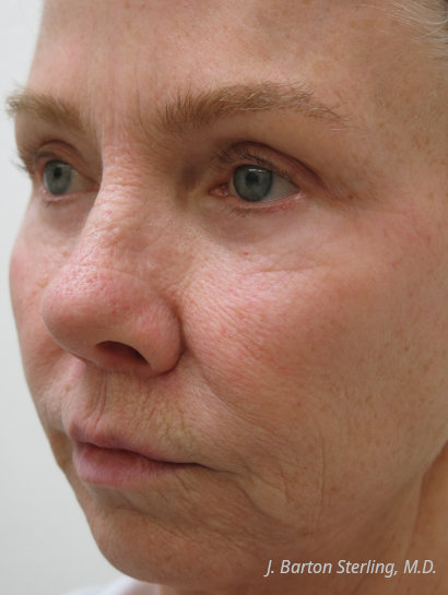 J Barton Sterling M.D. - Before Chemical Peel Sep 2025
