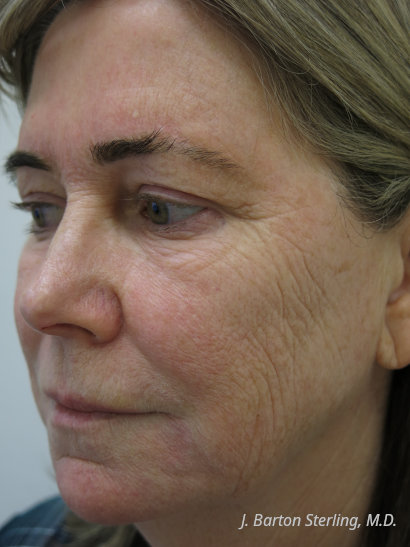 J. Barton Sterling, M.D. - Chemical Peel Before Sep 2026