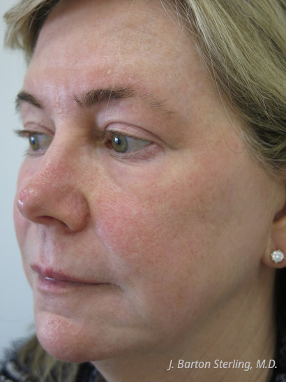 J. Barton Sterling, M.D. - Chemical Peel After Sep 2026